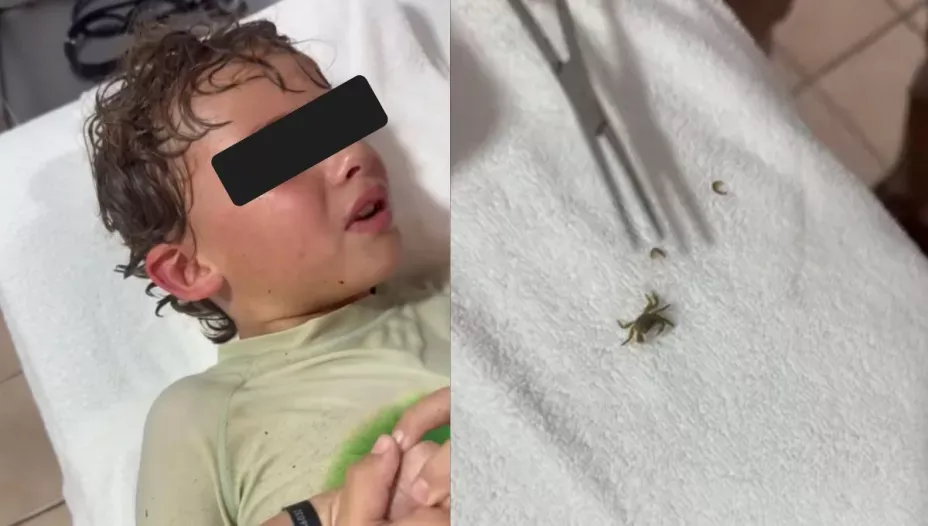 Tras un día en la playa: Extraen un cangrejo vivo del oído de un niño
