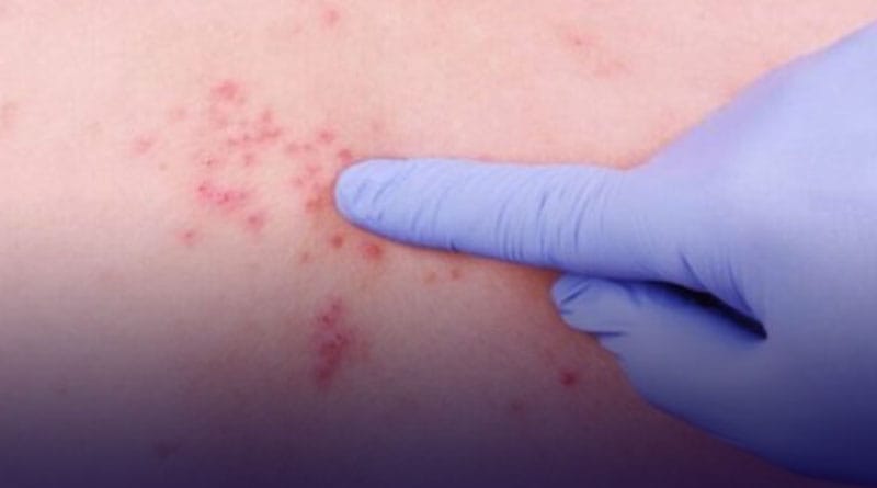 Alertan sobre posible epidemia de culebrilla en Sucre, Mérida y Barinas 