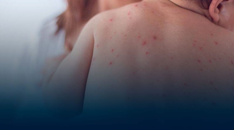 La Organización Panamericana de la Salud alerta sobre posibles brotes de sarampión en el país