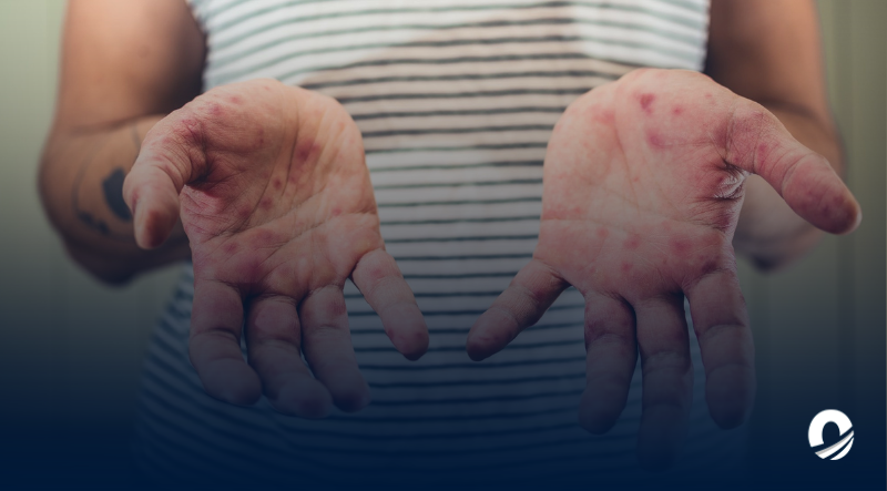 Presuntos casos de viruela del mono están siendo investigados en Honduras