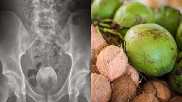 Hombre de 50 años fue operado en Brasil tras introducirse un coco en el ano