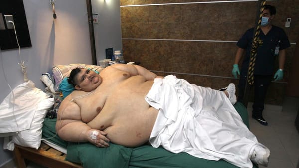 Falleció el hombre más gordo del mundo tras una infección renal en México