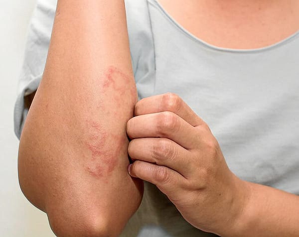 Monagas | Incrementan casos de sarna y asma producto de la falta de servicios