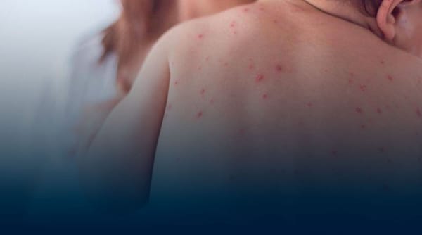 La Organización Panamericana de la Salud alerta sobre posibles brotes de sarampión en el país