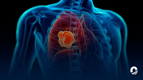 Cáncer de pulmón detección