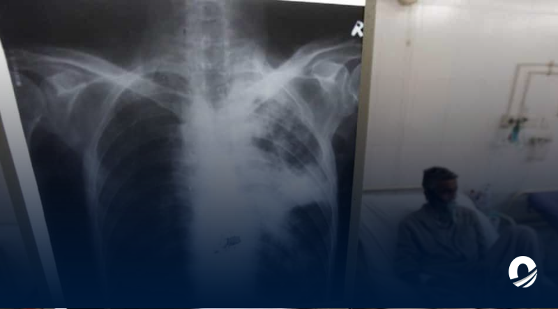 Médico aseguró que los hombres son los más afectados por tuberculosis en Venezuela