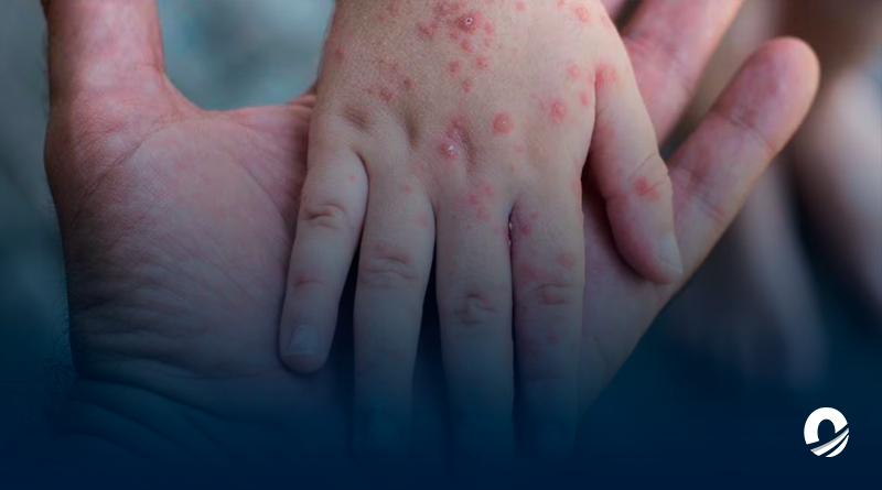 OMS advirtió ascenso 'alarmante' de casos de sarampión