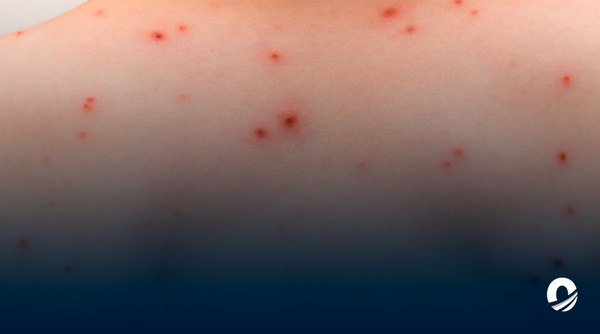 Academia Nacional de Medicina exigió medidas tras aumento de casos de sarampión