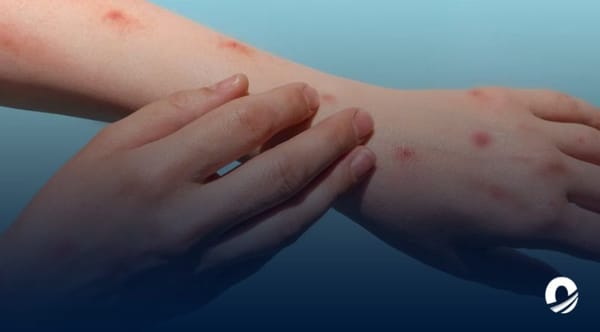 OMS viruela del mono emergencia sanitaria mundial