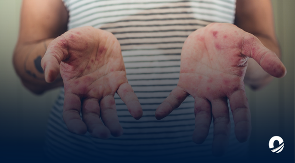 Siete casos de viruela del mono fueron confirmados en Ecuador